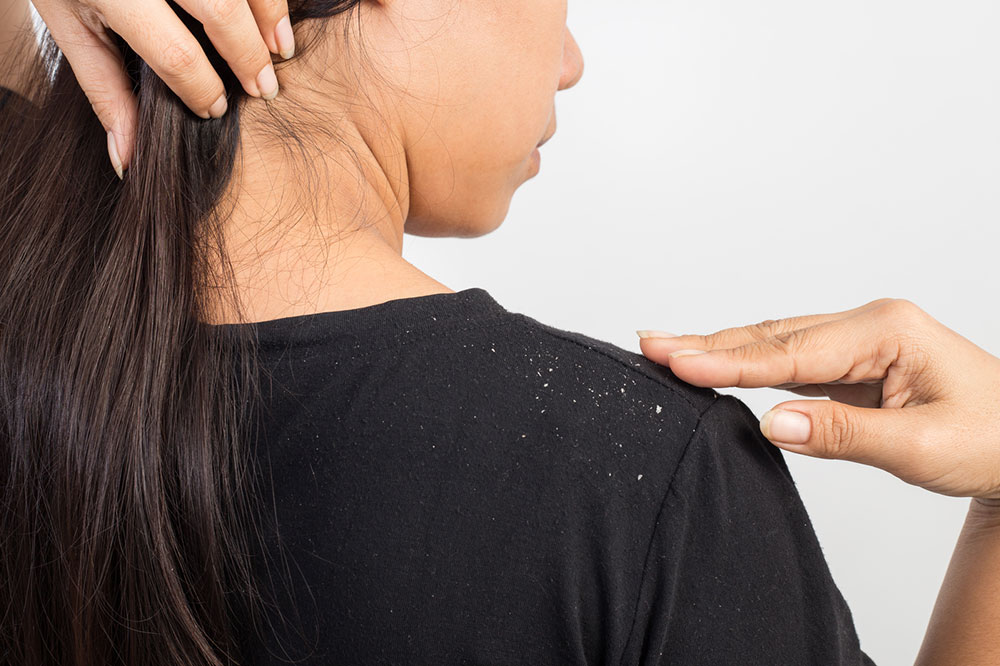 3 Natural Remedies for Dandruff