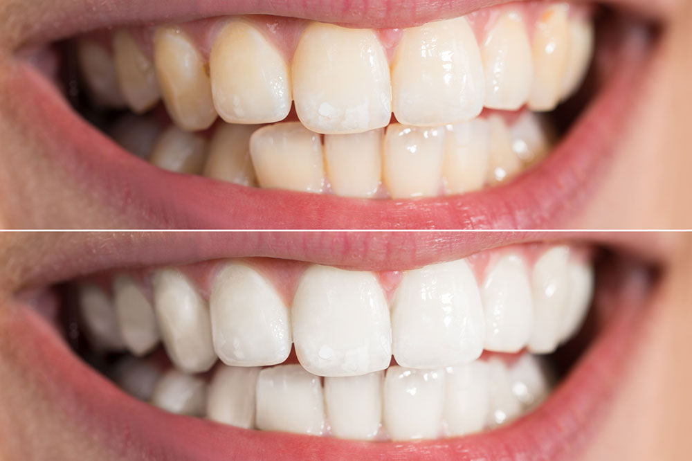 Effective Teeth Whitening Tips